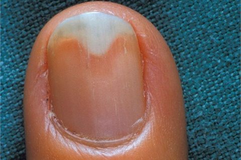 what causes a gray nail tip?