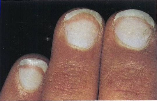What Causes Very White Fingernails?