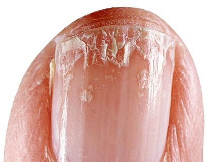 What Causes Dry Brittle Nails That Crack?