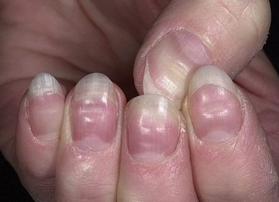 15 Health WARNINGS Your Fingernails Are Sending
