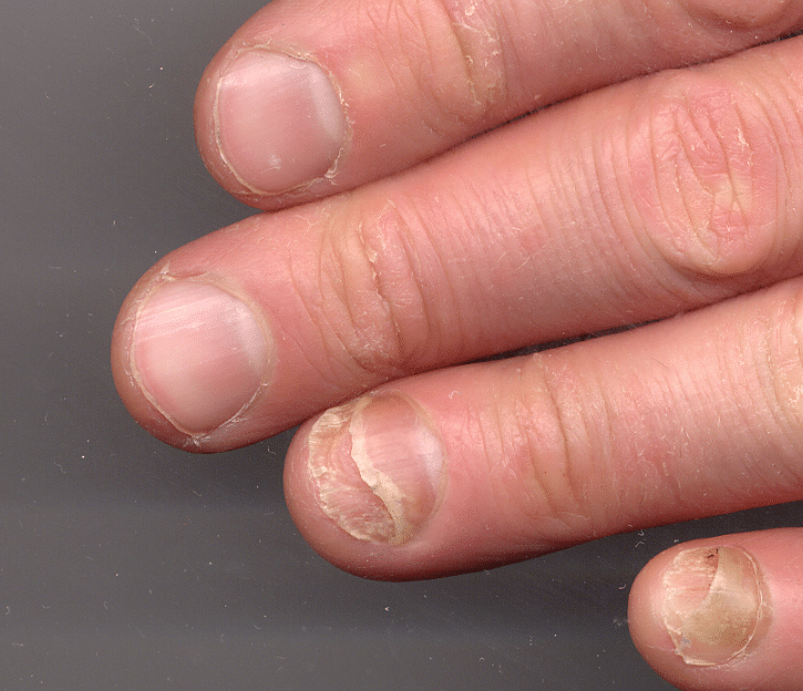 What causes nails to detach from their nail bed?