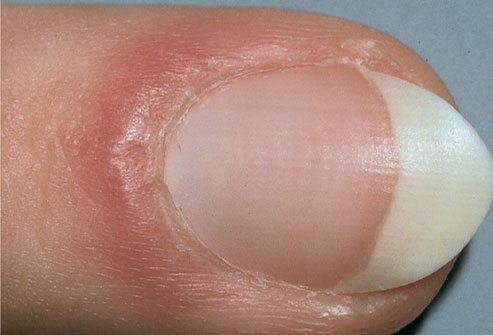 What is redness around your nail caused by?